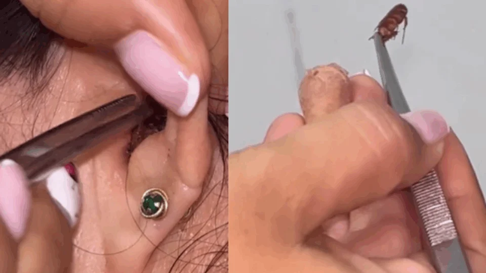 VEJA VÍDEO: após sentir ‘estouros’, mulher tem barata retirada do ouvido