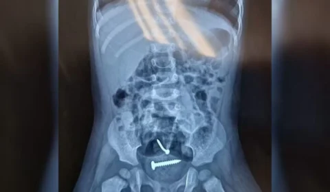 Parafusos são encontrados dentro de criança de 1 ano estuprada pelo pai