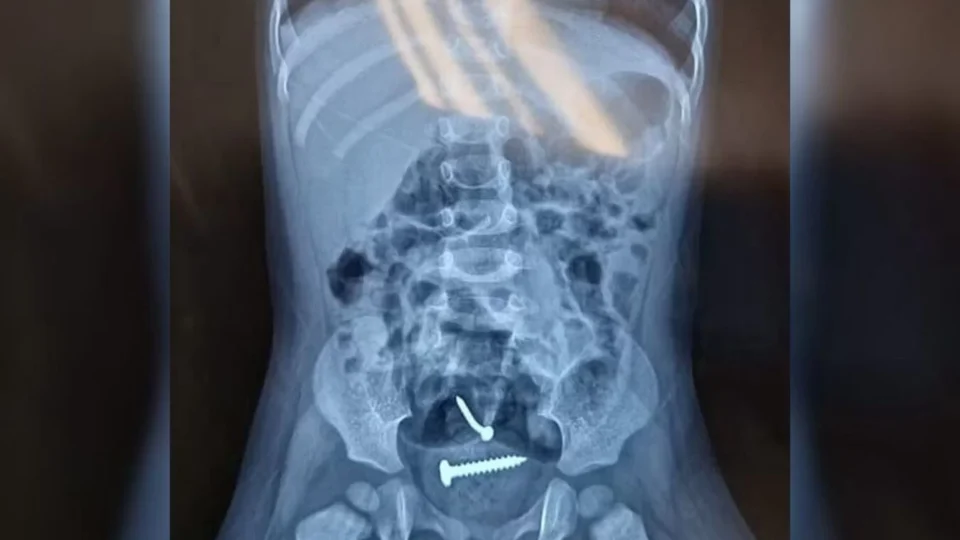 Parafusos são encontrados dentro de criança de 1 ano estuprada pelo pai