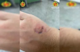 Dona de restaurante morde PM após pancadaria por causa de conta em bar