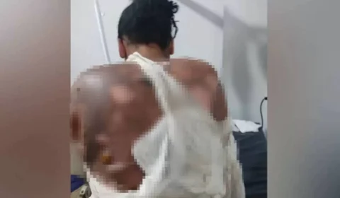 Adolescente tem 40% do corpo queimado após tentativa de feminicídio