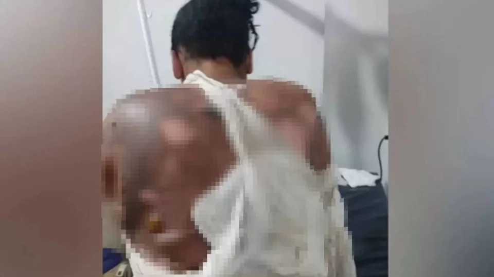 Adolescente tem 40% do corpo queimado após tentativa de feminicídio