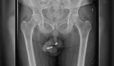 Idoso com impotência enfia 3 baterias no pênis e perde parte do órgão