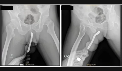 Homem coloca escova de dentes no pênis e objeto quebra durante sexo