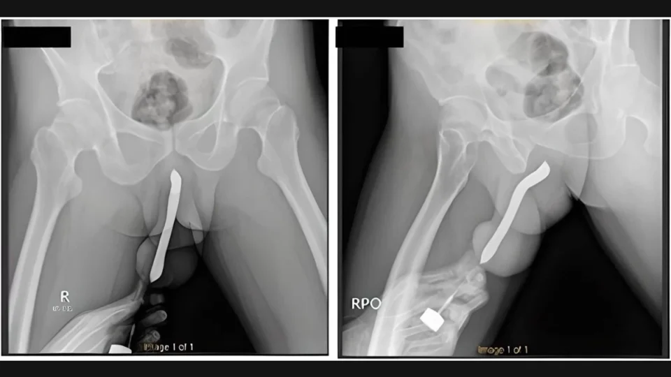 Homem coloca escova de dentes no pênis e objeto quebra durante sexo