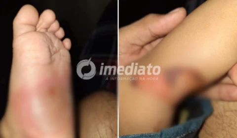 Bebê de 1 ano e 3 meses é vítima de brutal espancamento e queimaduras em Manaus