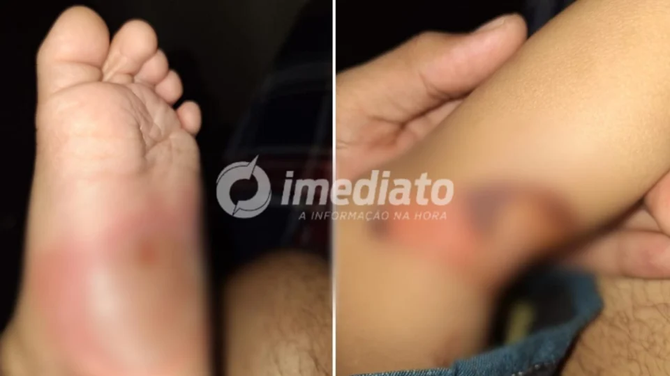 Bebê de 1 ano e 3 meses é vítima de brutal espancamento e queimaduras em Manaus