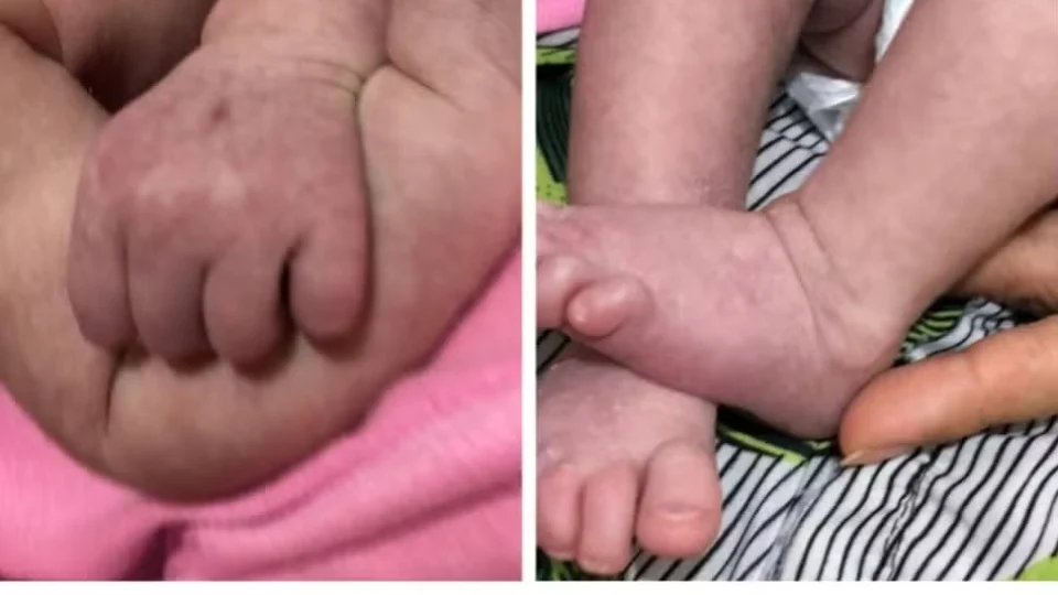 Bebê de 22 dias morre de dengue em Maceió