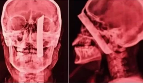 Mulher sobrevive após ser esfaqueada na cabeça em São Paulo