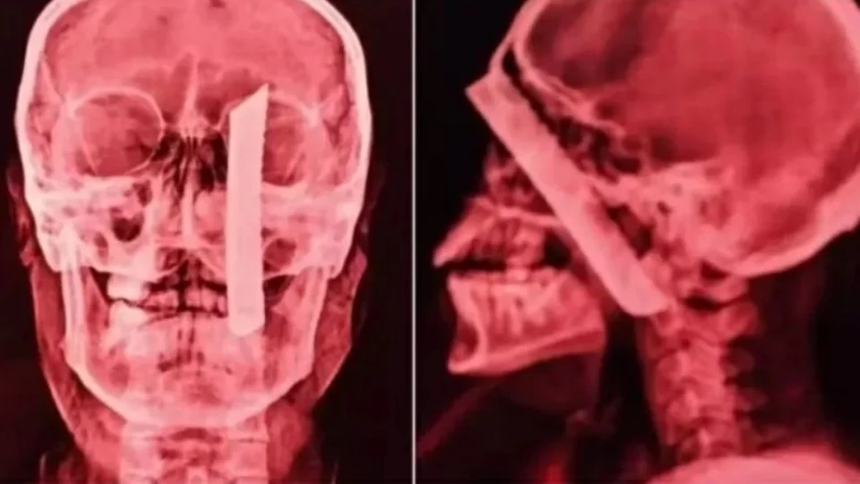 Mulher sobrevive após ser esfaqueada na cabeça em São Paulo