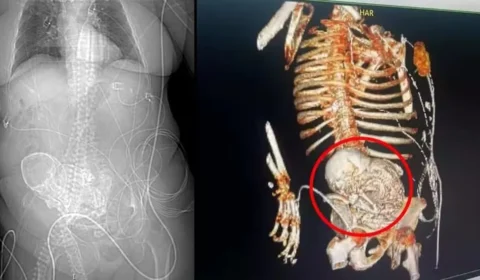 Idosa descobre feto calcificado que carregou por mais de 5 décadas e morre após cirurgia de retirada