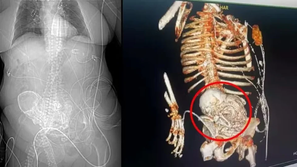 Idosa descobre feto calcificado que carregou por mais de 5 décadas e morre após cirurgia de retirada