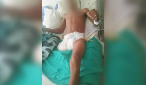 Preso tem perna amputada por negligência em unidade prisional de Roraima