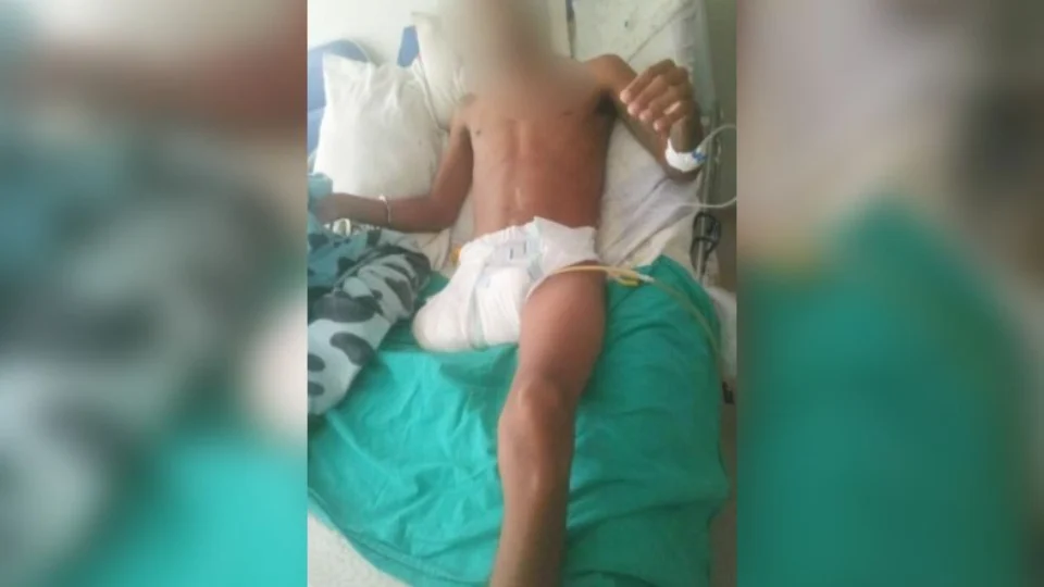 Preso tem perna amputada por negligência em unidade prisional de Roraima