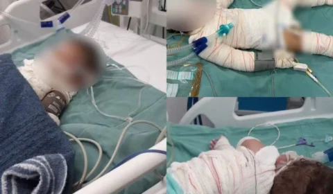 Criança de 3 anos morre 12 dias após explosão de churrasqueira