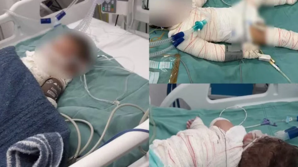 Criança de 3 anos morre 12 dias após explosão de churrasqueira