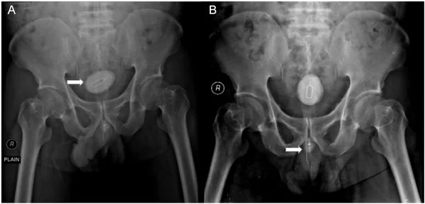 Homem passa por cirurgia após enfiar chave para retirar chip no pênis