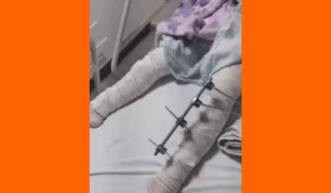 Menina de 6 anos tem pinos colocados em perna errada por erro médico