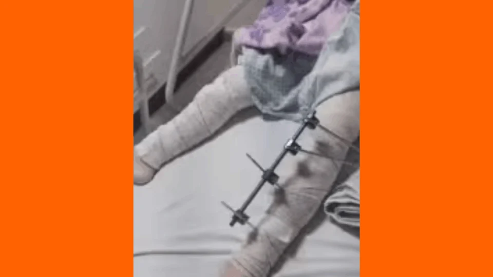 Menina de 6 anos tem pinos colocados em perna errada por erro médico