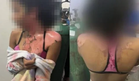 VÍDEO: Jovem de 14 anos é queimada com água quente pela tia por causa de ciúmes no DF