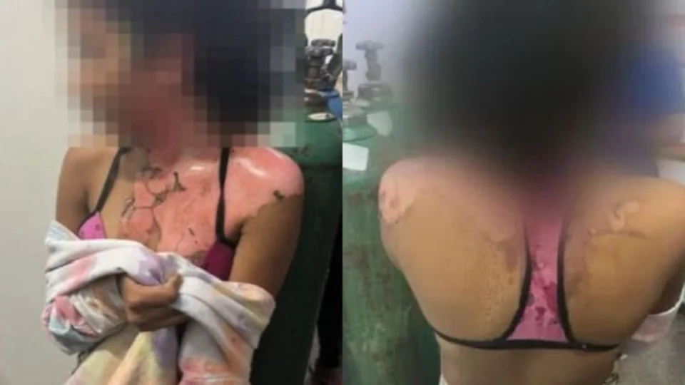 VÍDEO: Jovem de 14 anos é queimada com água quente pela tia por causa de ciúmes no DF