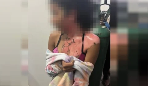 Vídeo: tia queima sobrinha de 14 anos com água fervendo