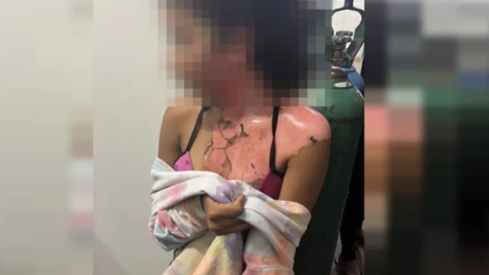Vídeo: tia queima sobrinha de 14 anos com água fervendo