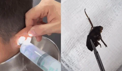 VEJA VÍDEO: médico tira barata e pedaços de frutas do ouvido de criança