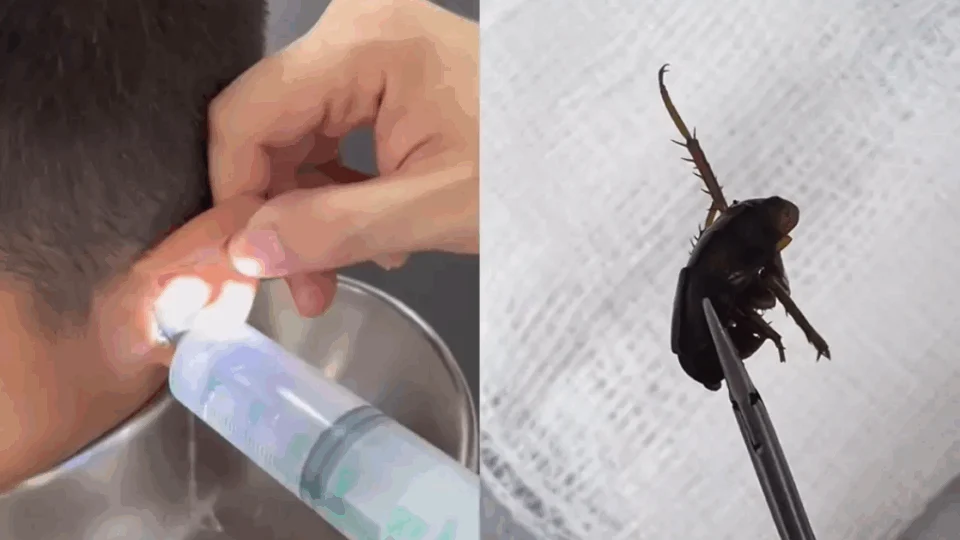 VEJA VÍDEO: médico tira barata e pedaços de frutas do ouvido de criança