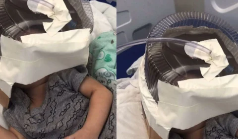 Bebê de 3 meses usa máscara de oxigênio improvisada com embalagem de bolo enquanto espera por vaga em UTI