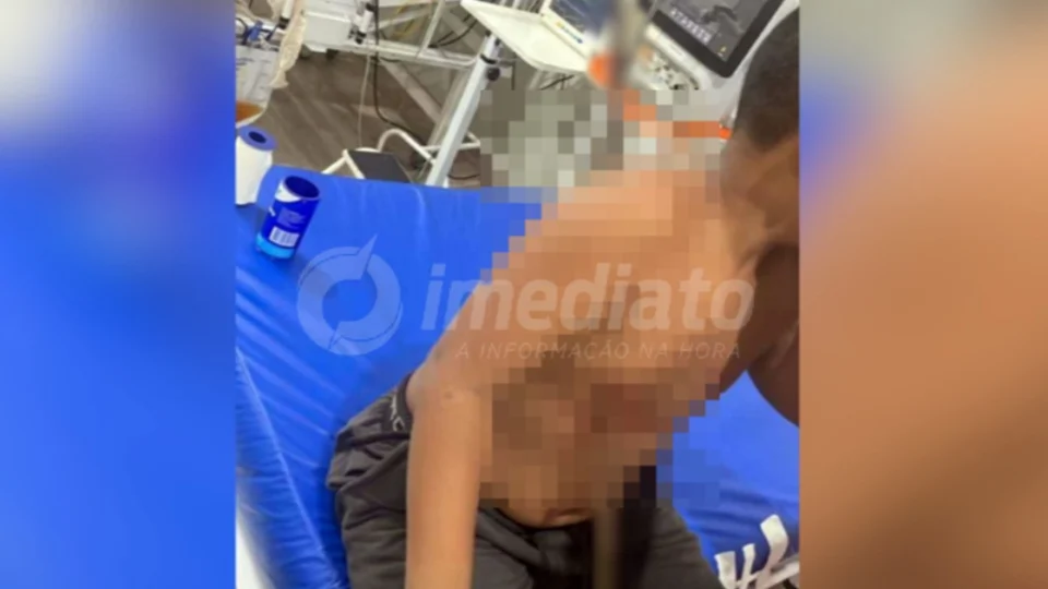 VEJA VÍDEO: menino fica com vergalhão atravessado no peito após brincar em obra