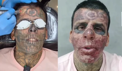 VEJA: Homem com tatuado na face se converte e vídeo de remoção de tatuagem viraliza