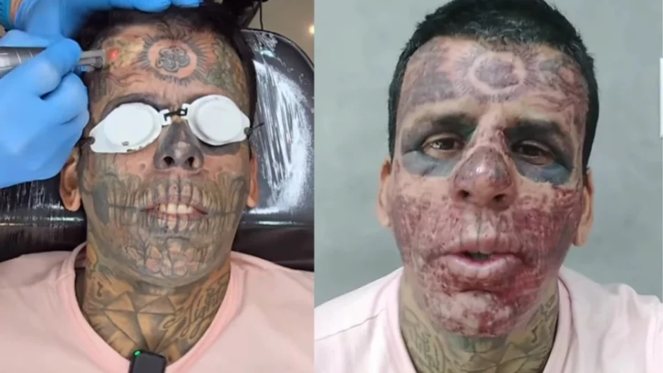 VEJA: Homem com tatuado na face se converte e vídeo de remoção de tatuagem viraliza