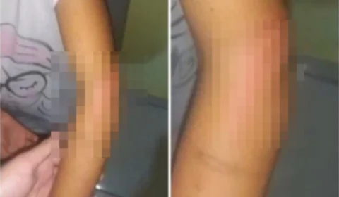 Mãe é presa após fraturar braço da filha de 5 anos a madeiradas