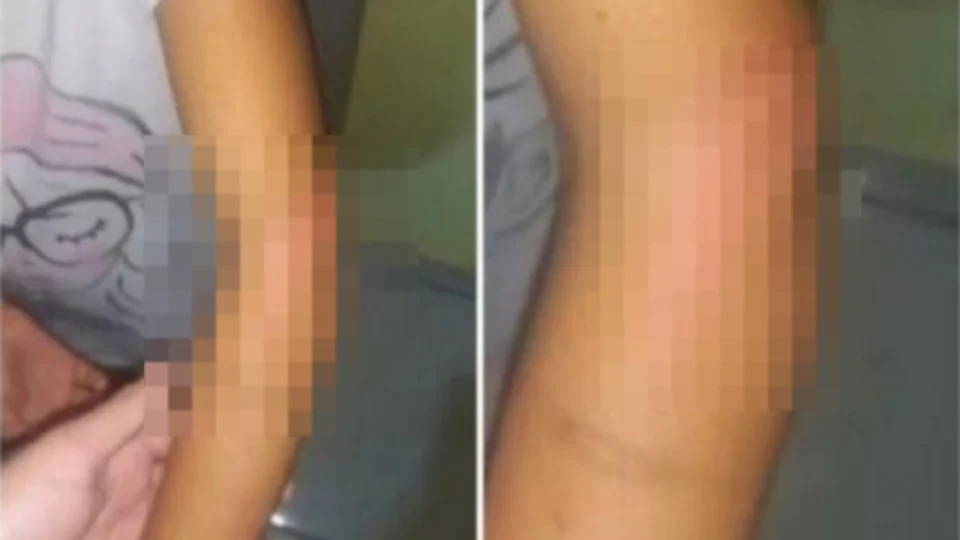 Mãe é presa após fraturar braço da filha de 5 anos a madeiradas