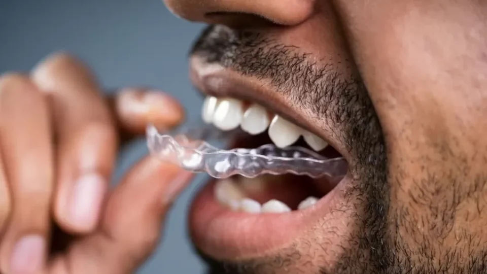 Duas vezes mais rápido e sem dor: aparelho dental ‘invisível’ se modernizou