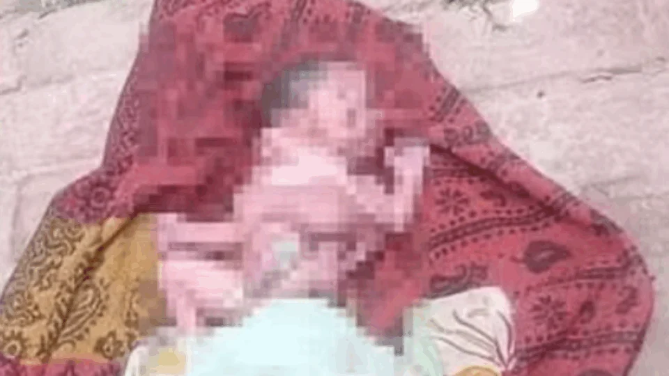 VEJA; Bebê nasce com quatro braços, quatro pernas e dois rostos na Índia
