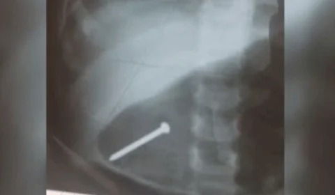 Bebê de 1 ano é internada após engolir prego enquanto brincava em casa