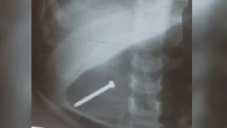 Bebê de 1 ano é internada após engolir prego enquanto brincava em casa