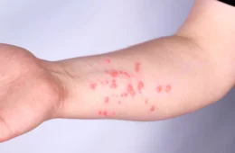 Mpox: nova variante tem maior transmissibilidade e mortalidade