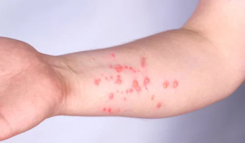 Mpox: nova variante tem maior transmissibilidade e mortalidade