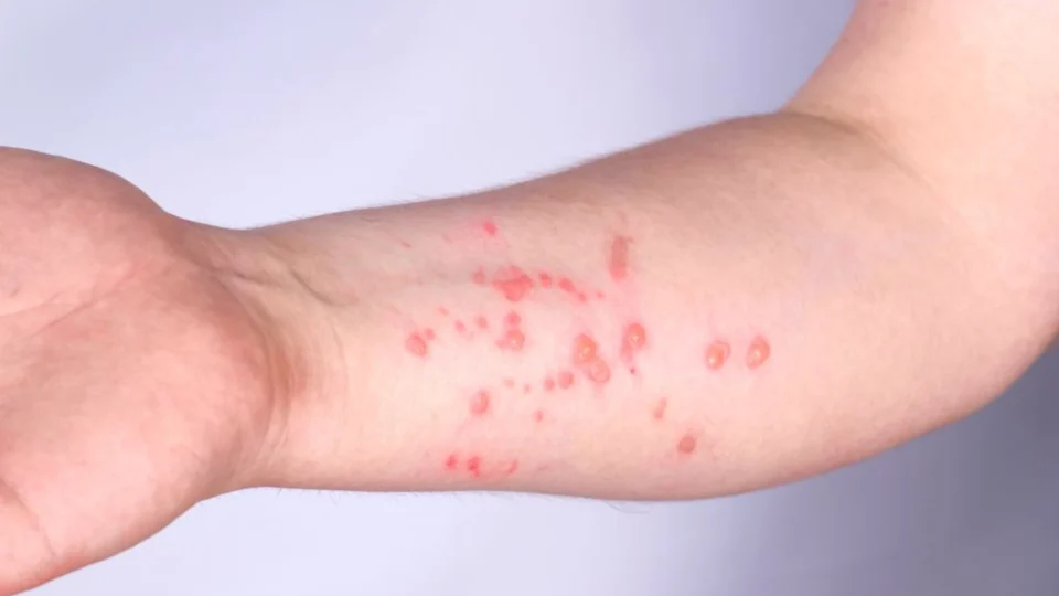 Mpox: nova variante tem maior transmissibilidade e mortalidade