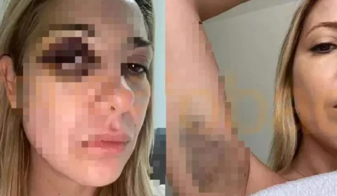 Ex-primeira-dama da Argentina mostra hematomas após agressões de Alberto Fernández