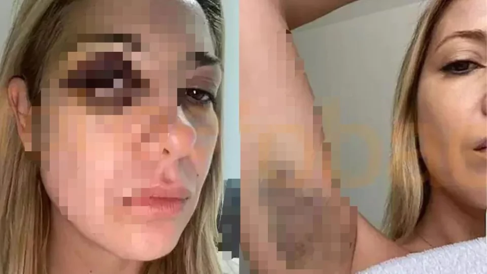 Ex-primeira-dama da Argentina mostra hematomas após agressões de Alberto Fernández