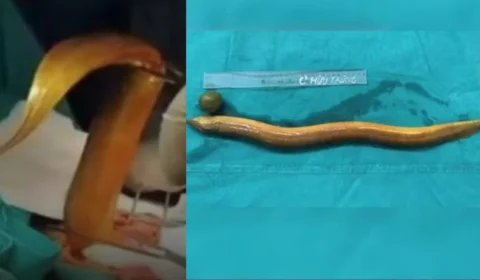 Homem enfia enguia e limão no ânus em busca de prazer e passa por cirurgia de emergência