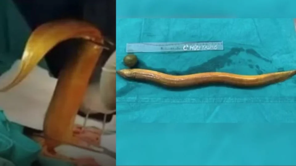 Homem enfia enguia e limão no ânus em busca de prazer e passa por cirurgia de emergência