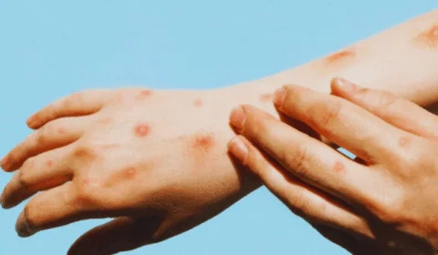OMS avalia se mpox deve voltar a ser declarada emergência global
