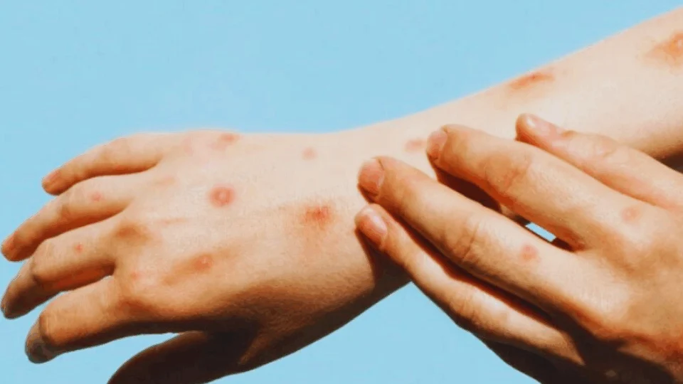 OMS avalia se mpox deve voltar a ser declarada emergência global