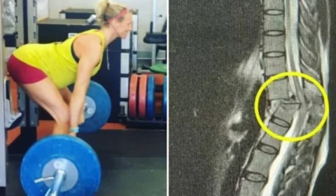 Professora fica paralisada após acidente com barra de 120kg durante treino