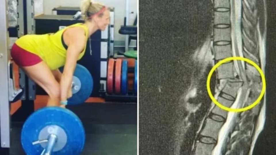 Professora fica paralisada após acidente com barra de 120kg durante treino